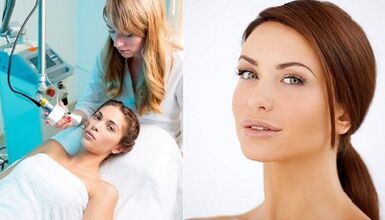 Ihe kachasị mkpa nke usoro ntugharị akpụkpọ anụ laser